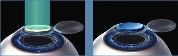 Fase 2 CORRECCIÓN VISUAL LÁSER Aguascalientes Líderes en Corrección Visual con Láser en Aguascalientes, Examen Visual y Salud Ocular